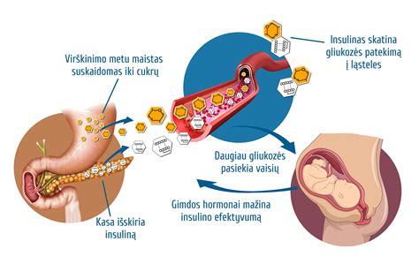 Gestacinio diabeto poveikis vaisiaus augimui gimdoje