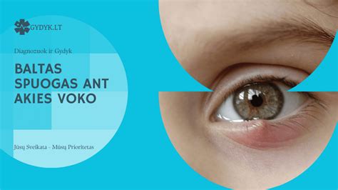 Papilomos ant akies voko