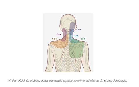 Stuburo srities skausmų schema