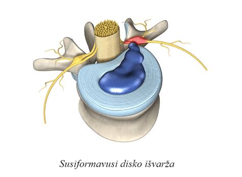 Stuburo biomechanikos schema su apkrovomis