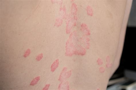 Psoriazės pažeista oda