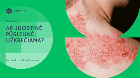 Pūslelinės viruso perdavimo ir prevencijos būdai