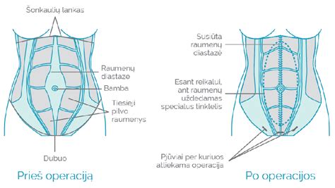 Schema, kaip atsiranda pilvo sienos išvarža