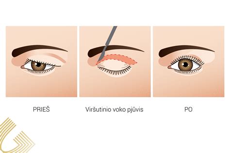 Akių vokų paraudimas ir patinimas