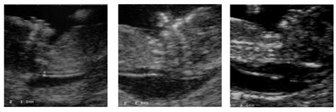Ultragarsinis matavimas sprando vaiskumos