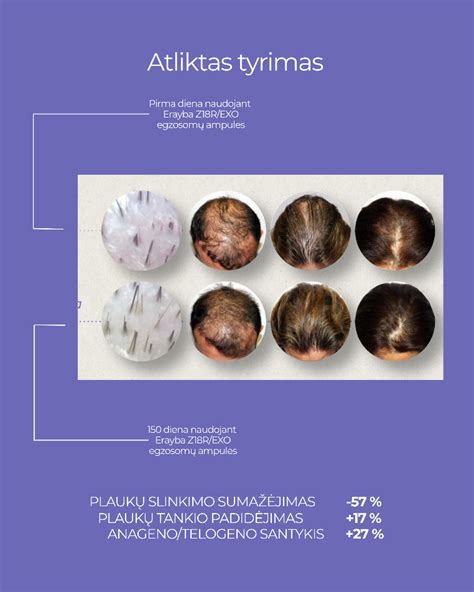 Plaukų slinkimo prevencija