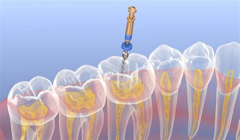 Schema: danties šaknų kanalų gydymo eiga