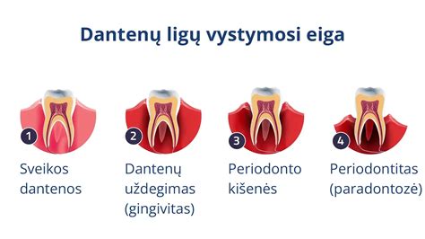 Dantenų uždegimo simptomai: paraudusios, patinusios ir kraujuojančios dantenos