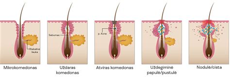 Aknės pažeistos odos schema