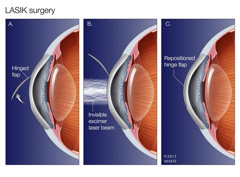 LASIK operacijos principas