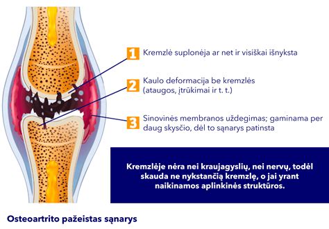 Podagros paveiktas sąnarys